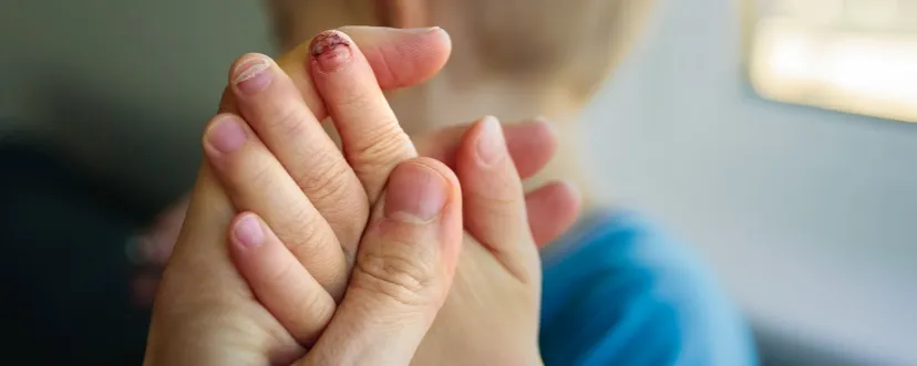 Zdjęcie Jak schodzi paznokieć - przyczyny, objawy i skuteczne leczenie
