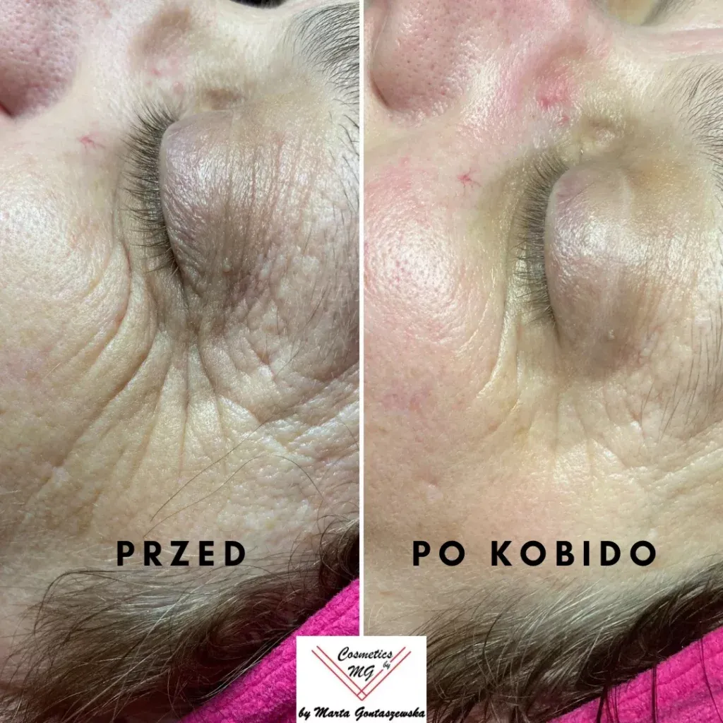 Zdjęcie Jak długo utrzymują się efekty masażu Kobido? Odkryj prawdę!