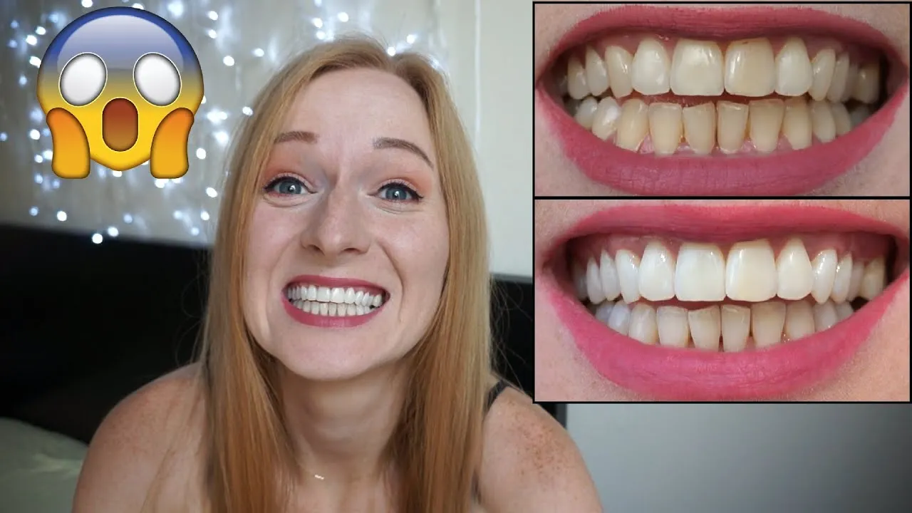 przed i po wybielaniu zębów