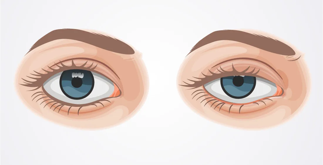 krople do oczu na opadającą powiekę apraklonidyna