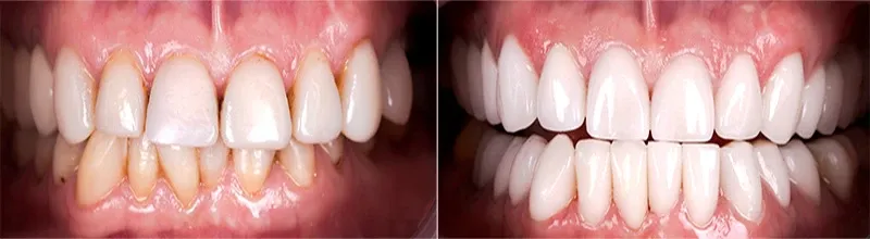 Stomatologia estetyczna przed i po
