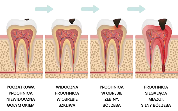 różne stadia próchnicy zębów