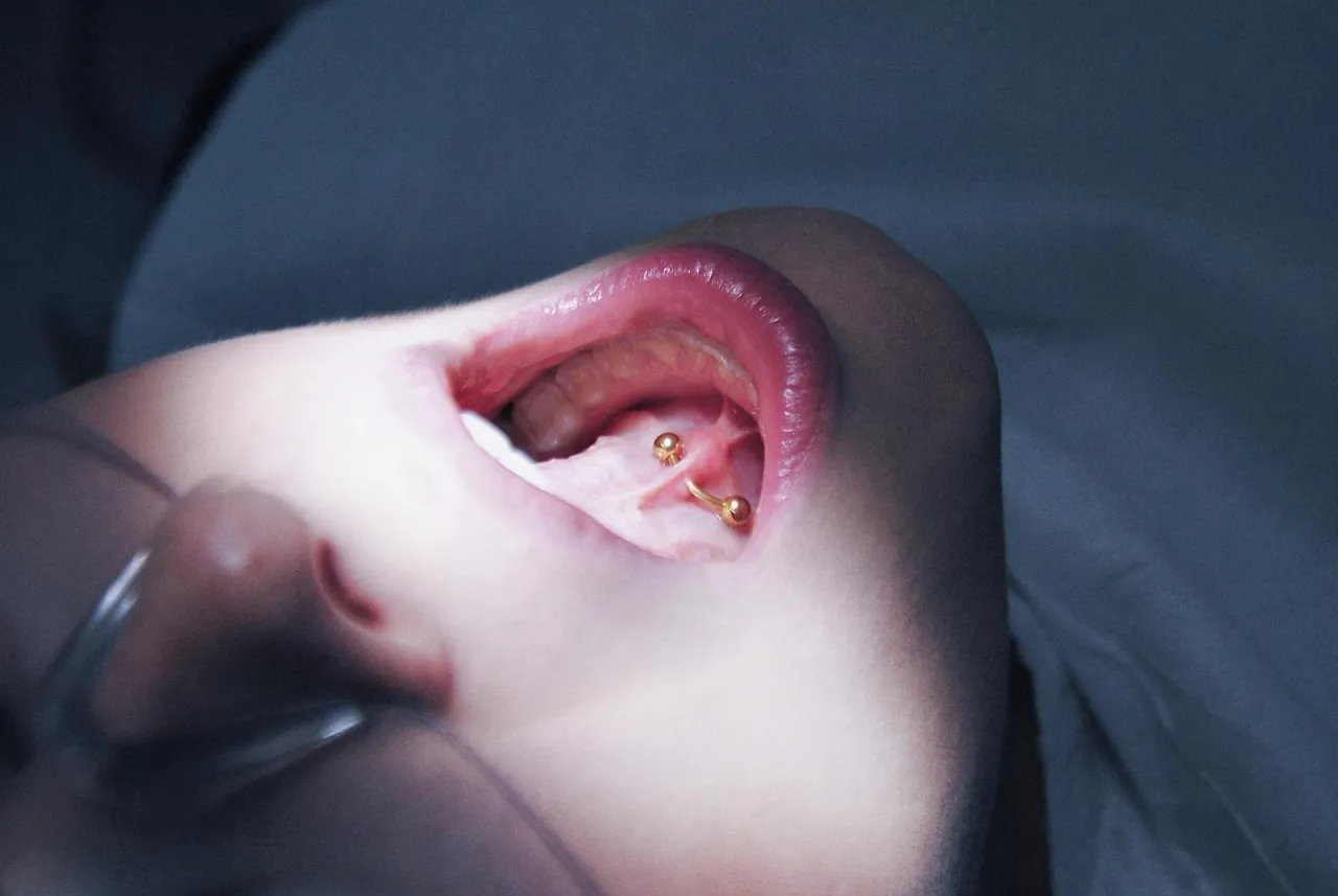 Uszkodzenia zęb&oacute;w od kolczyka w języku, recesja dziąseł od piercingu