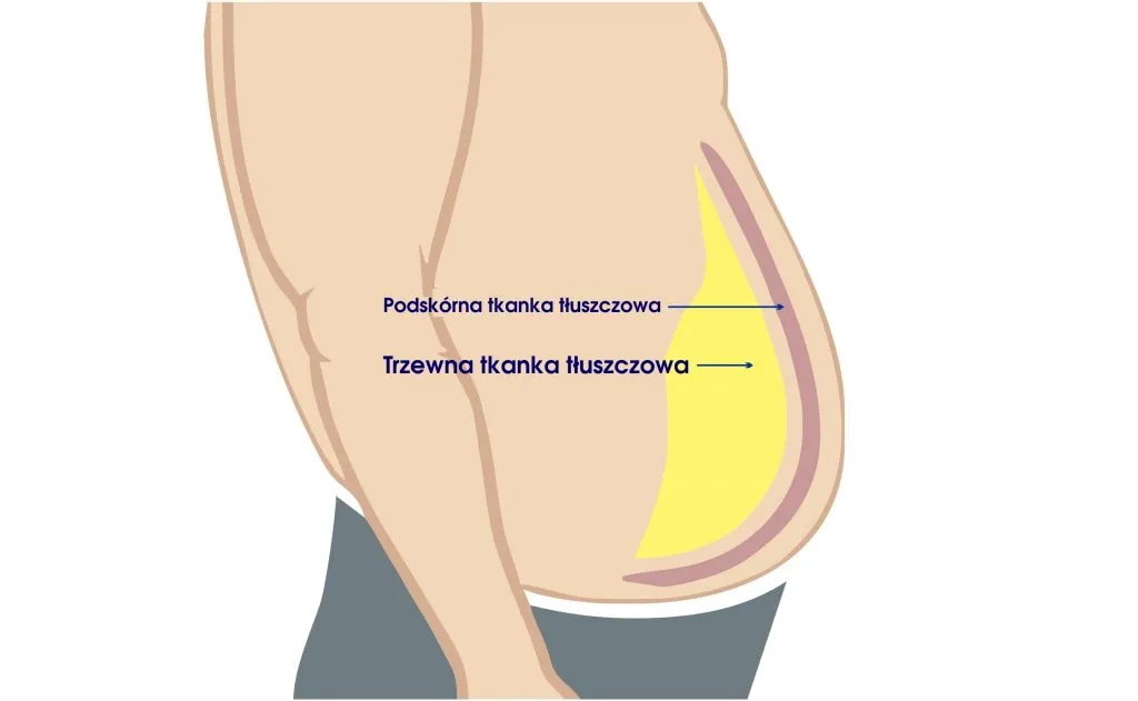 tłuszcz trzewny a podskórny różnice