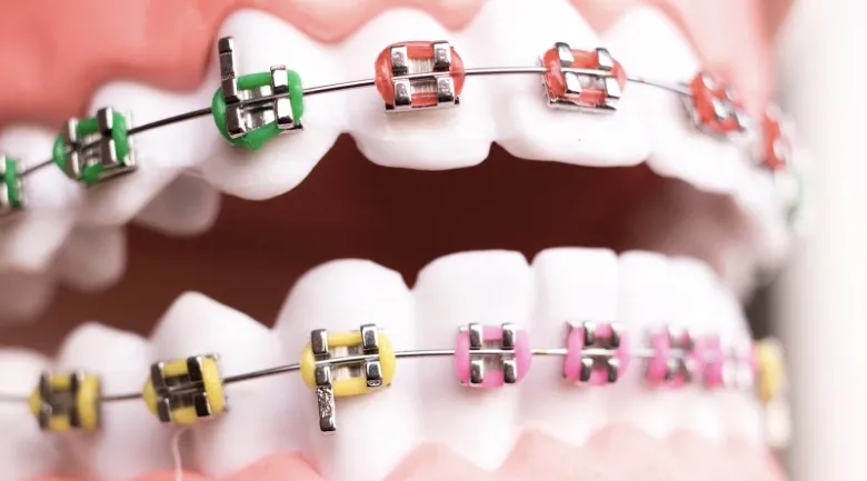 Różne typy aparatów ortodontycznych (metalowy, ceramiczny, nakładki)