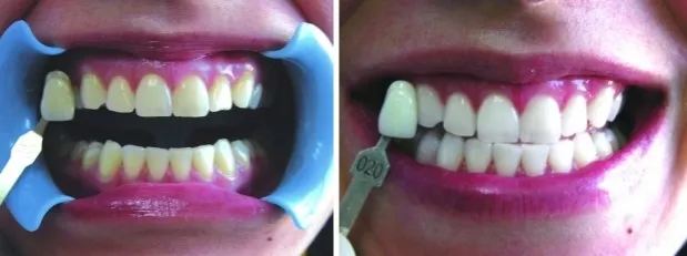 profesjonalne wybielanie zębów przed i po