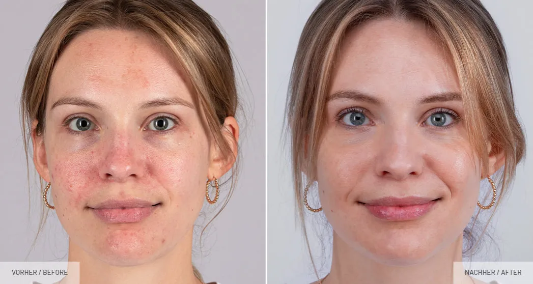 Vorher Nachher Hautpflege Ergebnisse