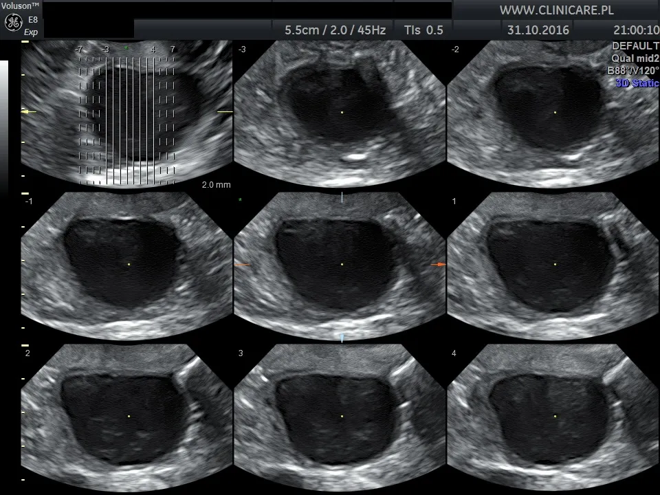 USG dopochwowe obraz