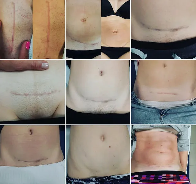 fizjoterapeuta uroginekologiczny po cesarskim cięciu