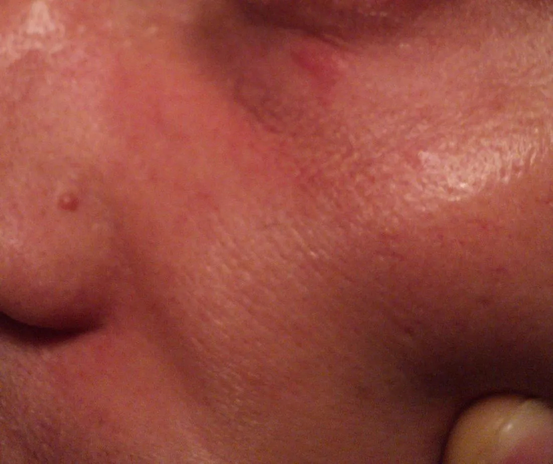 Zdjęcie Dlaczego pryszcze wyskakują w tym samym miejscu? Oto najczęstsze przyczyny