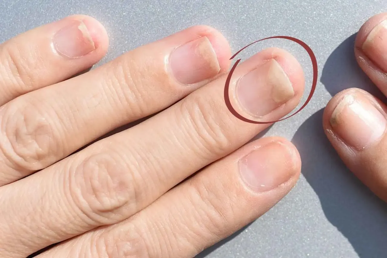 przyczyny okluzji paznokcia, uszkodzony paznokieć