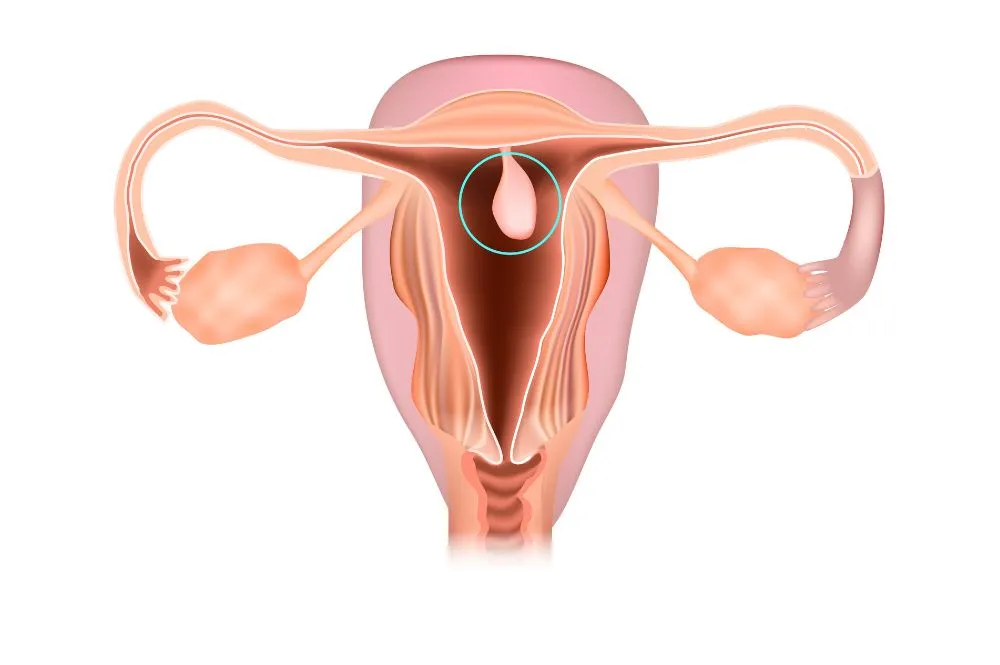 mięśniaki macicy i polipy endometrialne schemat