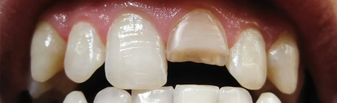 Objawy pękniętego korzenia zęba, b&oacute;l zęba, obrzęk dziąsła