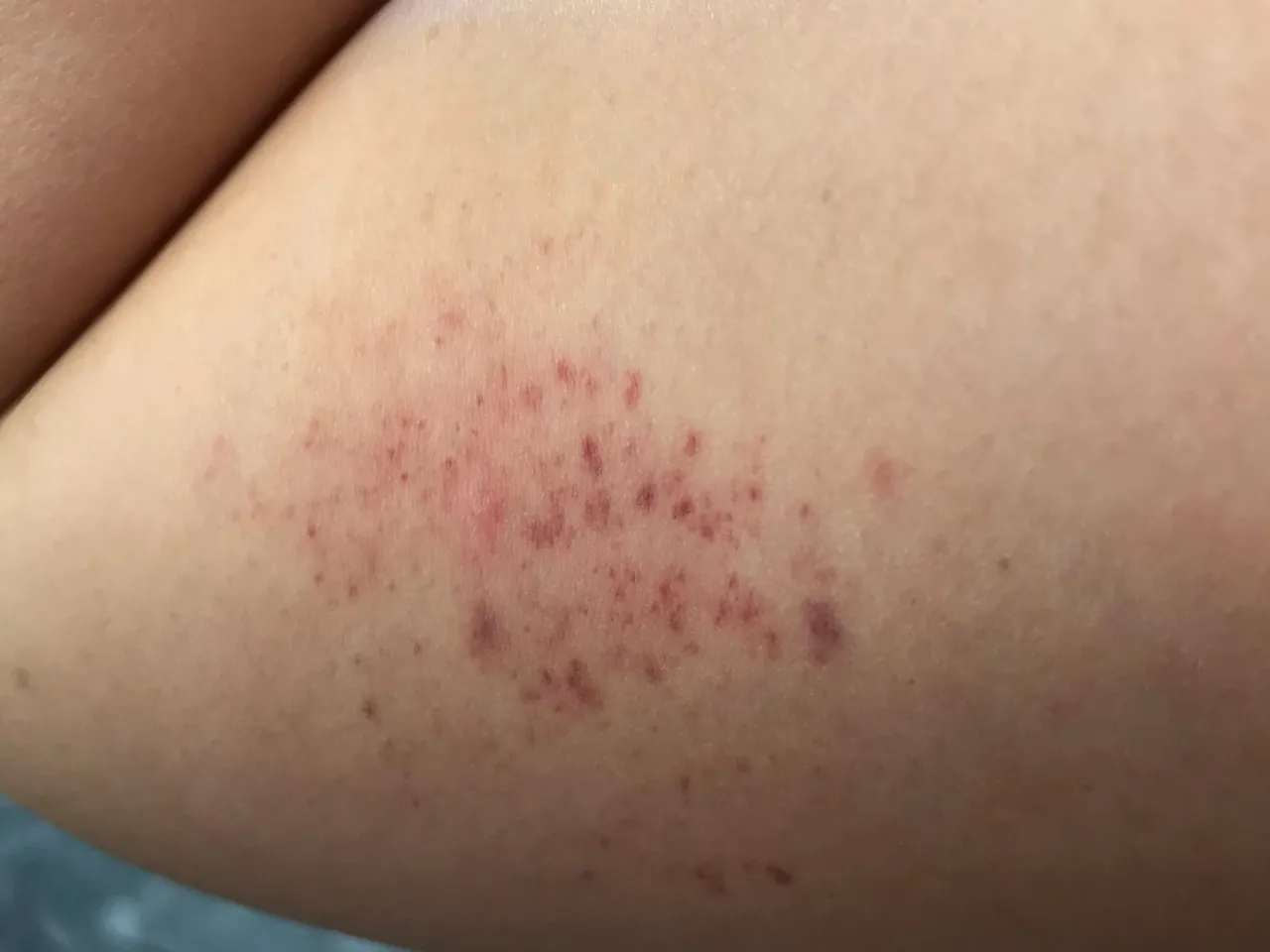 objawy skazy krwotocznej, siniaki wybroczyny, krwawienia sk&oacute;rne