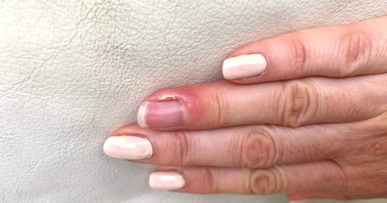 Objawy infekcji paznokcia po urazie