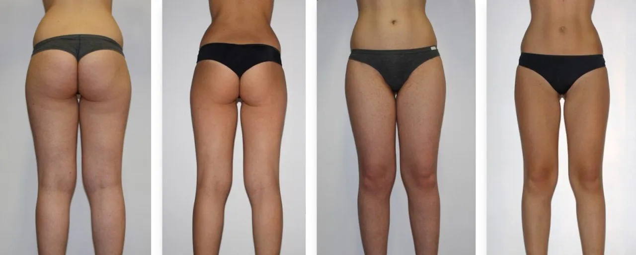 endermologia Alliance przed i po