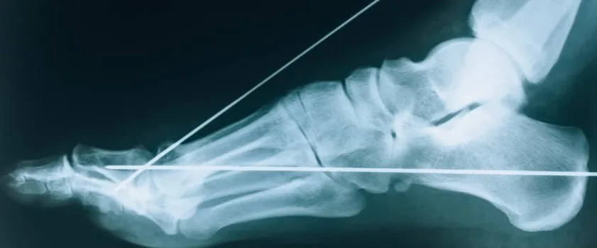 rentgen kostki usg stawu skokowego