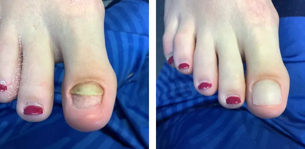 rekonstrukcja paznokcia przed i po
