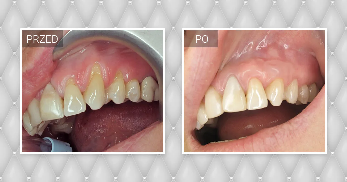 przeszczep dziąsła przed po