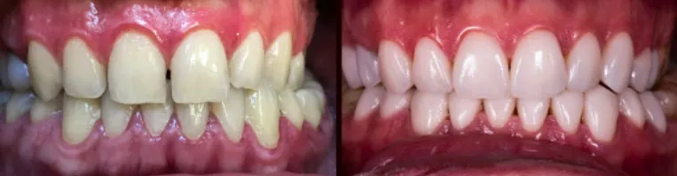 porównanie licówek kompozytowych i porcelanowych