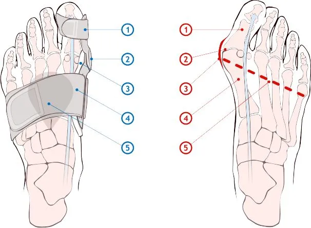R&oacute;żne typy ortez na haluksy por&oacute;wnanie