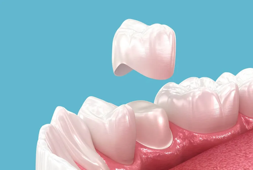 Rodzaje koron zębowych porównanie estetyki