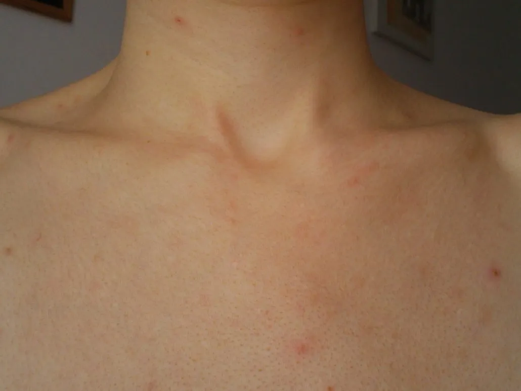 składniki aktywne na pryszcze dekolt