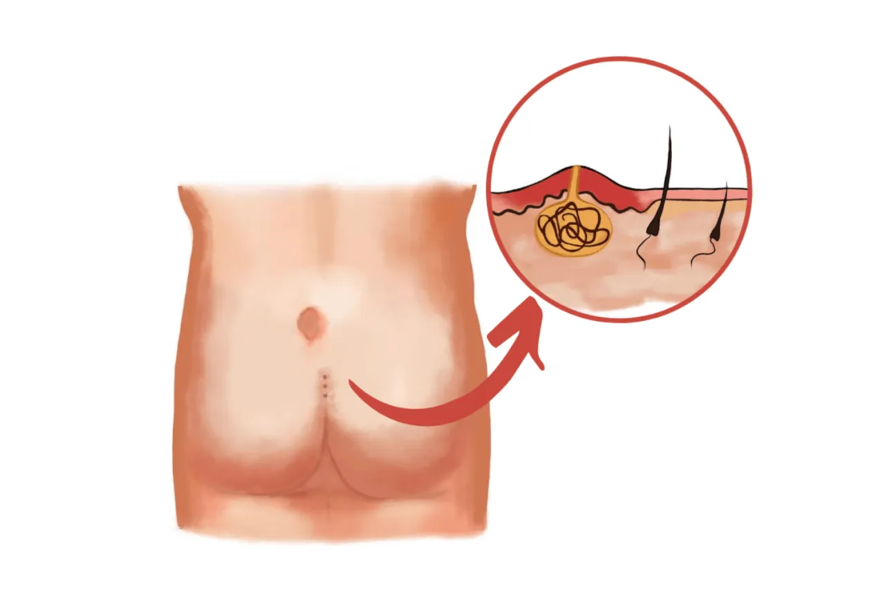 torbiel pilonidalna objawy, ropień szpary międzypośladkowej