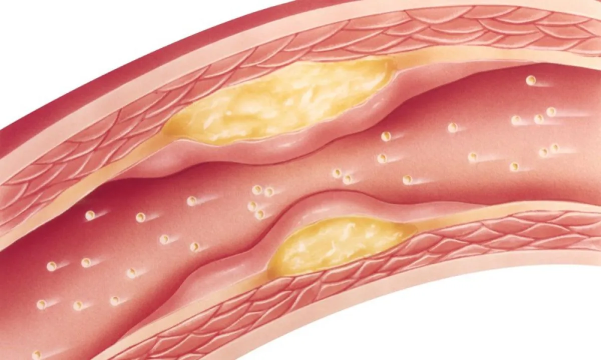 leczenie miażdżycy tętnic