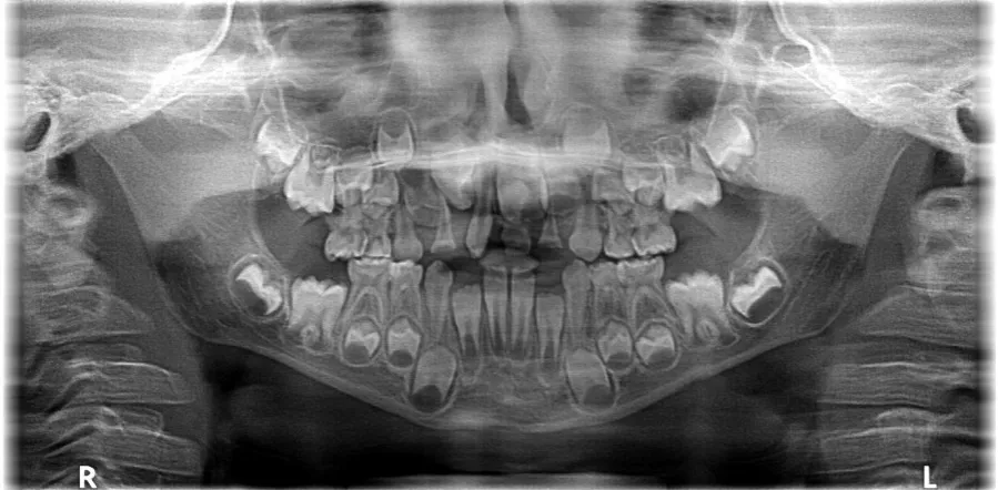 hiperdoncja mezjodens zdjęcie rtg