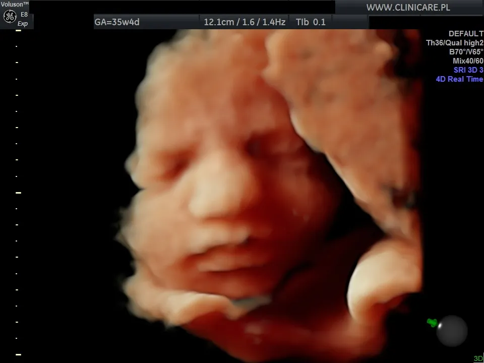 USG ciąża trzeci trymestr