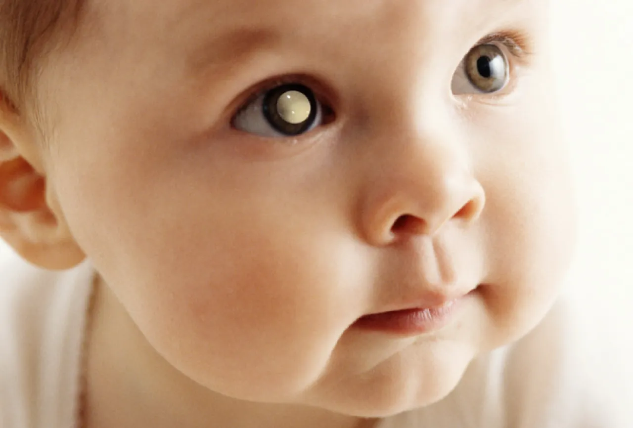 leukokoria u dziecka zdjęcie, biała źrenica niemowlę