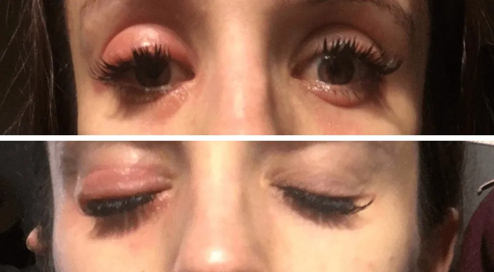 Składniki kleju do rzęs i alergie