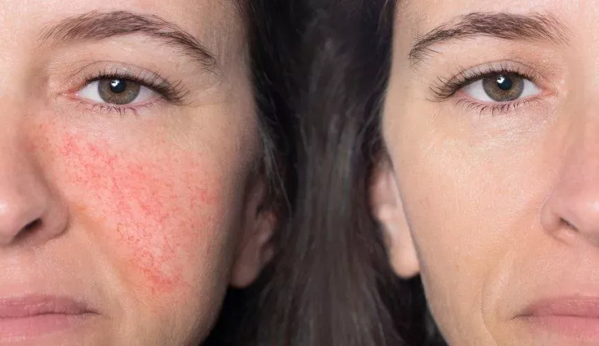 Składniki aktywne wzmacniające cerę naczynkową