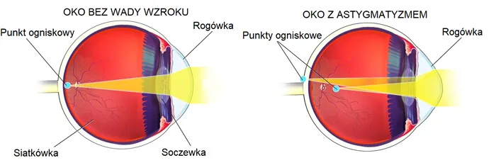 r&oacute;żne metody korekcji astygmatyzmu grafika