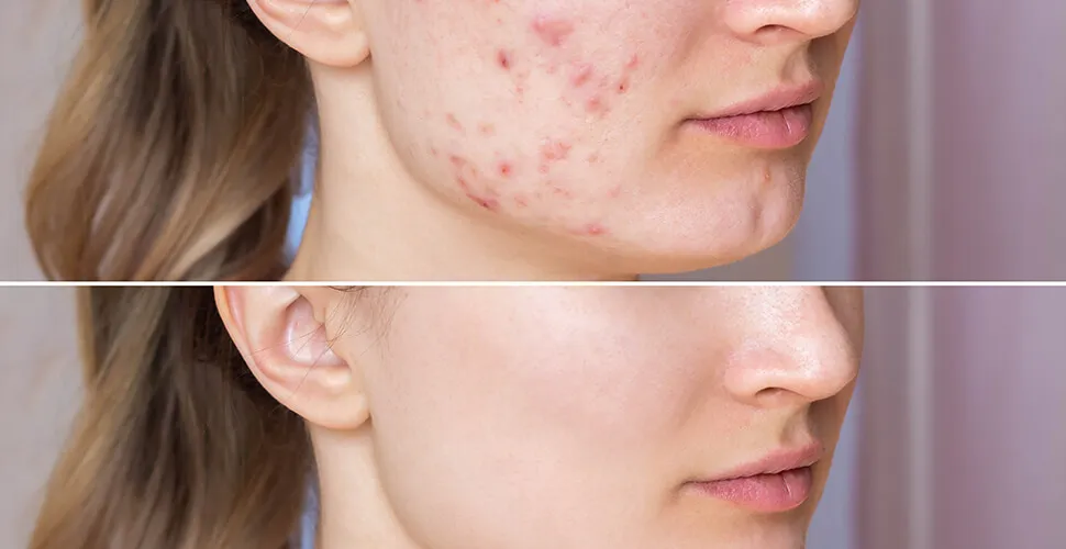 zdrowa cera pielęgnacja, składniki kosmetyków na trądzik