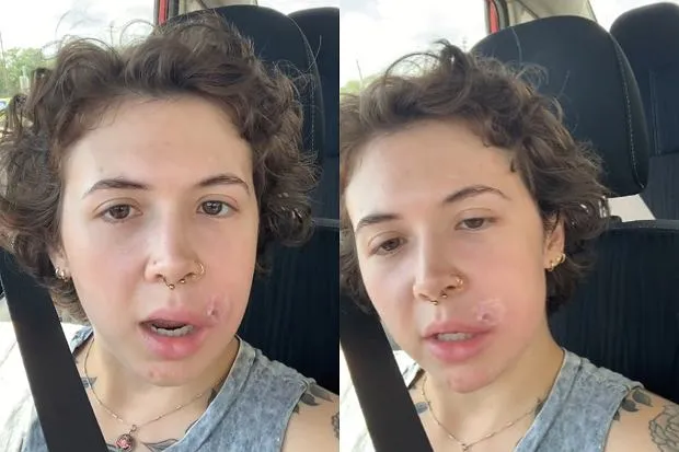 kobieta wyciskająca pryszcz z negatywnymi konsekwencjami