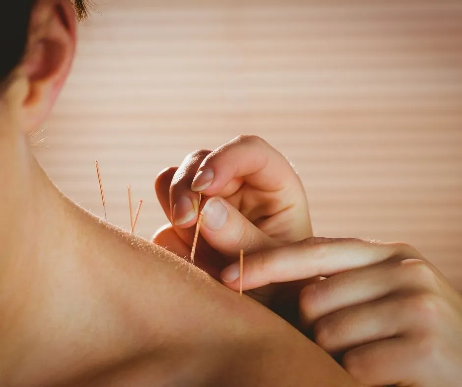 Zdjęcie Suche igłowanie vs akupunktura: Kluczowe r&oacute;żnice i wyb&oacute;r terapii