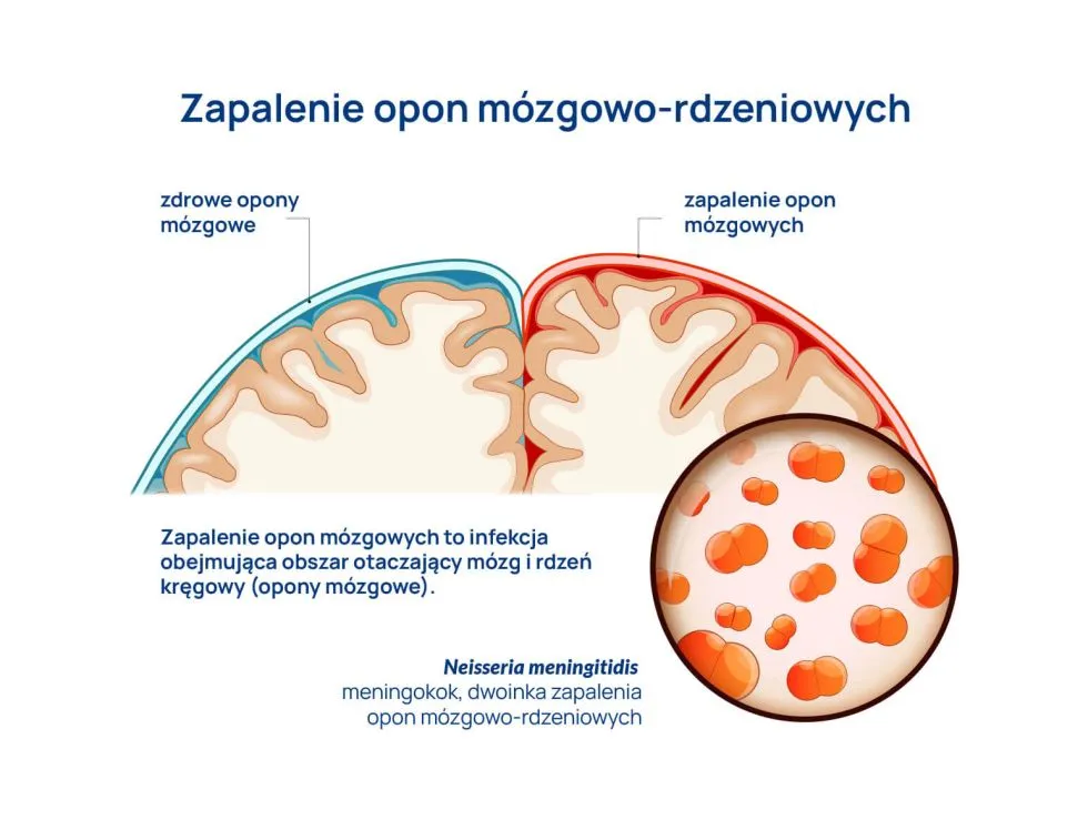 Zdjęcie Zapalenie opon mózgowych objawy u dorosłych – nie bagatelizuj tych sygnałów