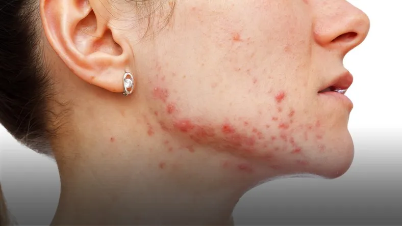 Zdjęcie Skuteczne sposoby na pryszcze na twarzy – uniknij trądziku już dziś