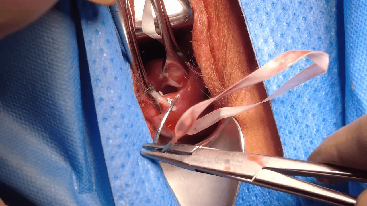 szew okrężny szyjki macicy cerclage