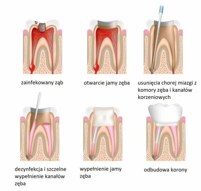 leczenie kanałowe zęba schemat