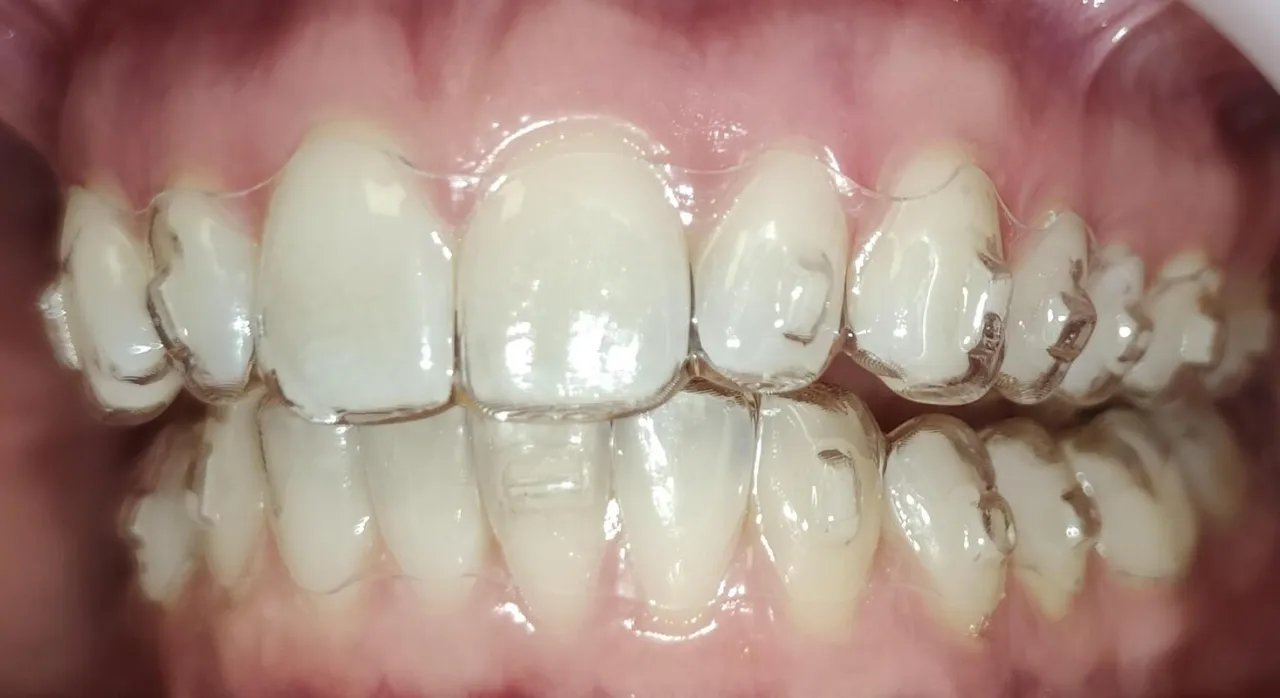 uszkodzone i przebarwione nakładki ortodontyczne