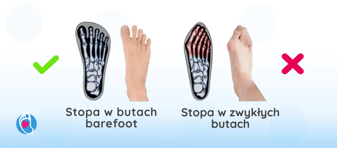 r&oacute;żne rodzaje obuwia zdrowe i niezdrowe dla st&oacute;p