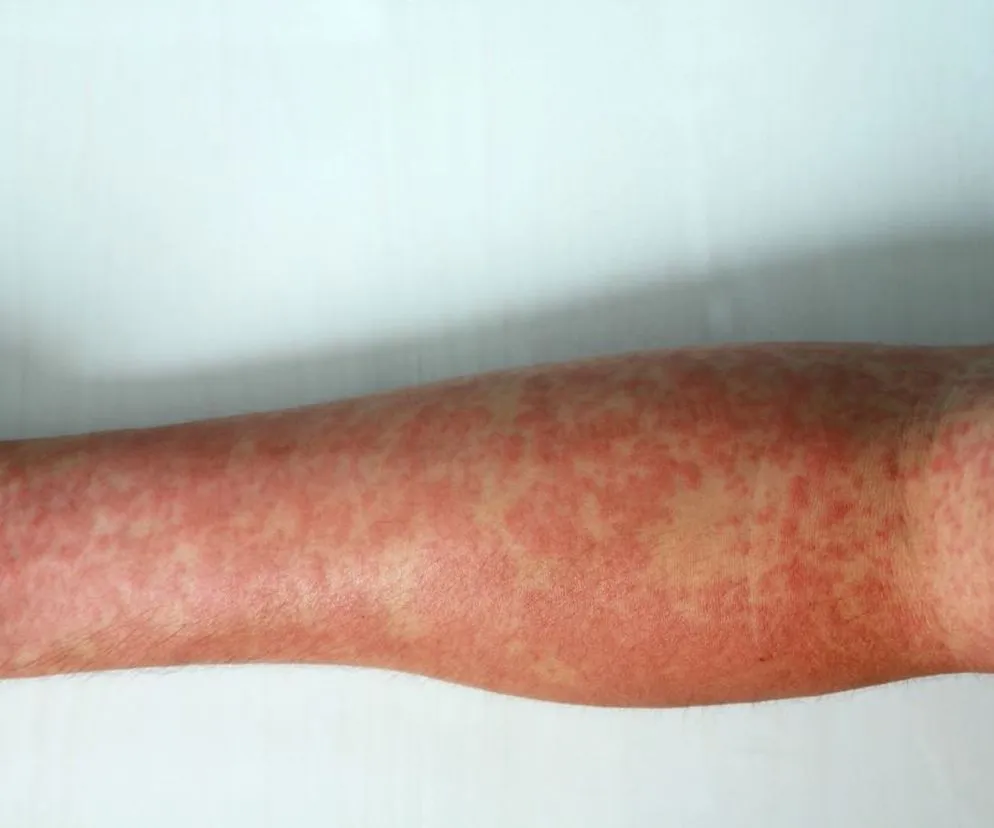 Przykłady chorób naczyniowych