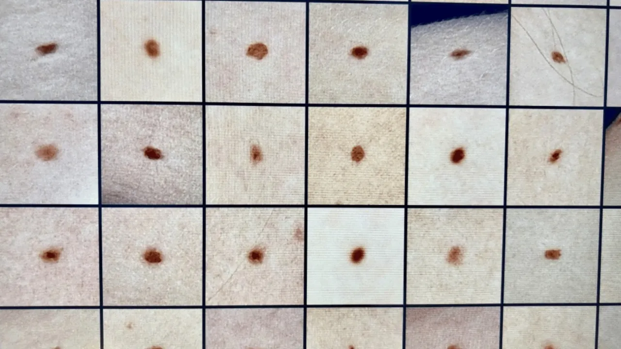 Dermatolog wykonujący badanie dermatoskopowe