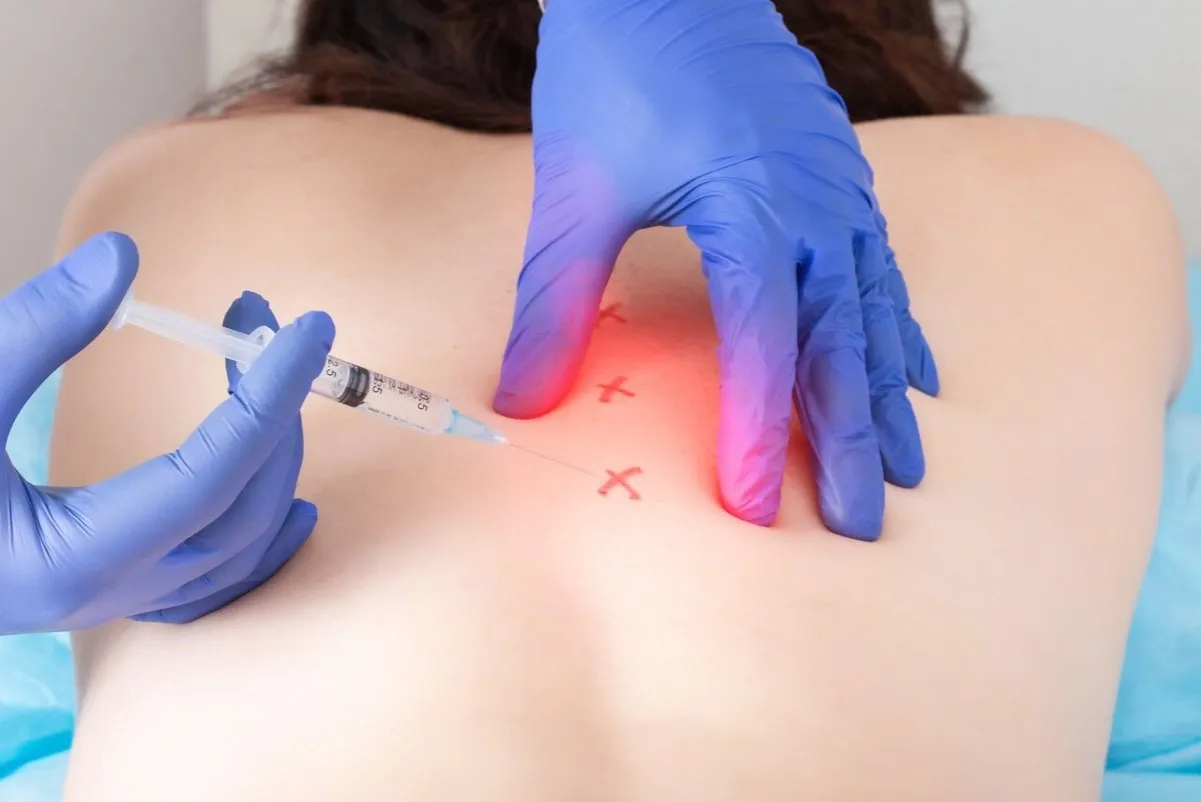 Zastrzyki blokady kręgosłupa