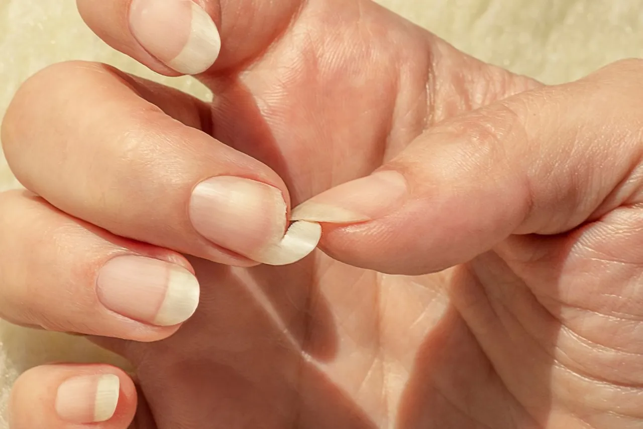 pękające paznokcie wzdłuż przyczyny