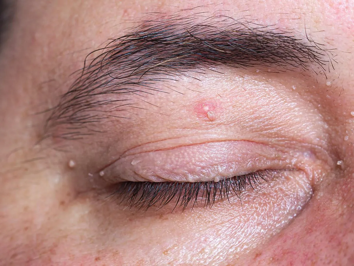 Widoczna biała kropka na powiece, drobne zmiany skórne wokół oka i brwi.