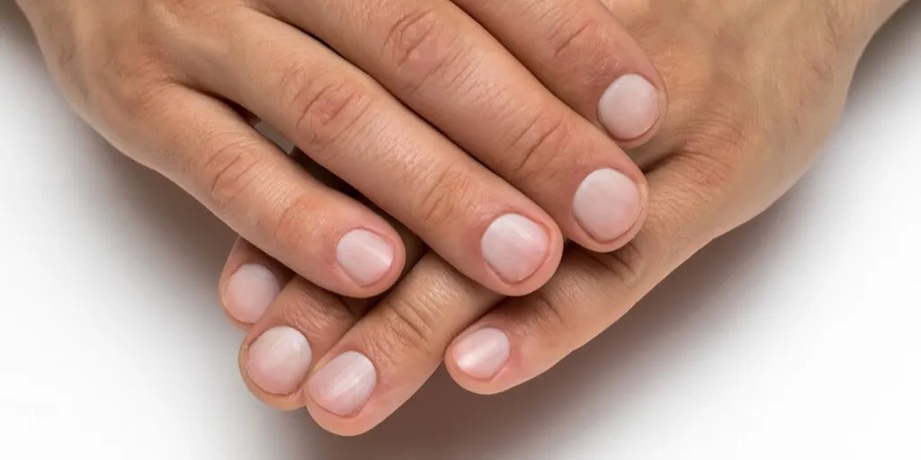 Podłużne bruzdy na paznokciach różne typy i nasilenie